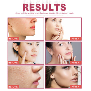 Rosehip Oil Treatment - Skin Moisturizing | 10ml, Natural