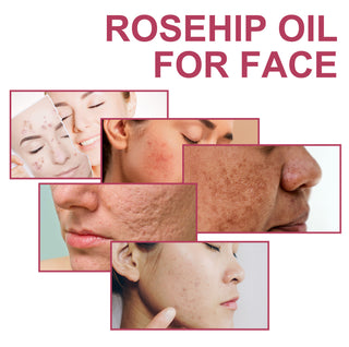 Rosehip Oil Treatment - Skin Moisturizing | 10ml, Natural
