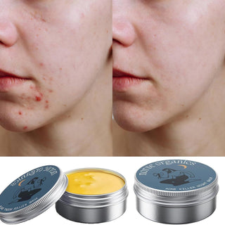 Acne Treatment Cream, Muscle Joint Skin Moisturizing Cream